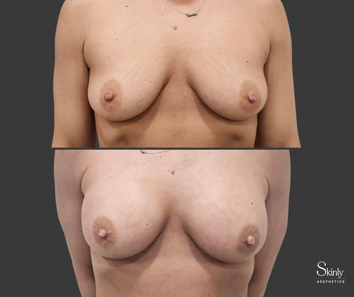 Fuller, youthful-looking breasts after filler injections at Skinly Aesthetics