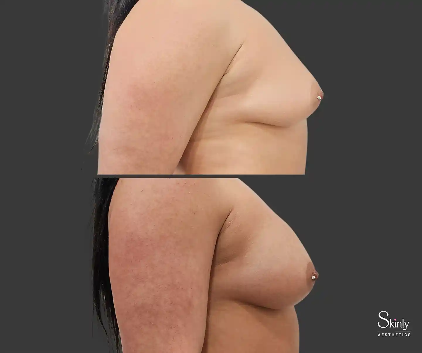Enhanced breast volume from the side after Liquid Breast Lift at Skinly Aesthetics NYC