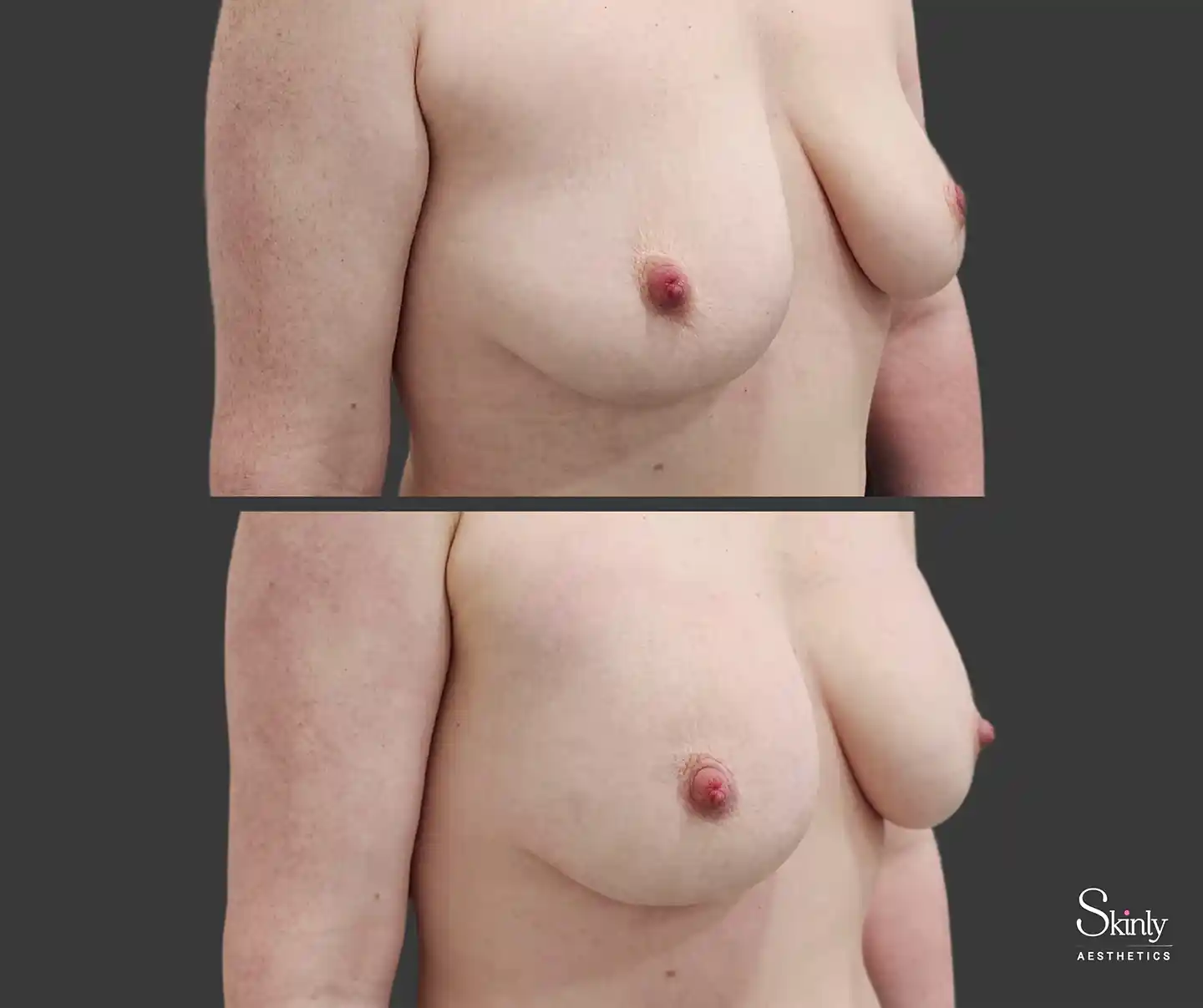 Noticeable side profile improvement in breast fullness after Liquid Breast Lift
