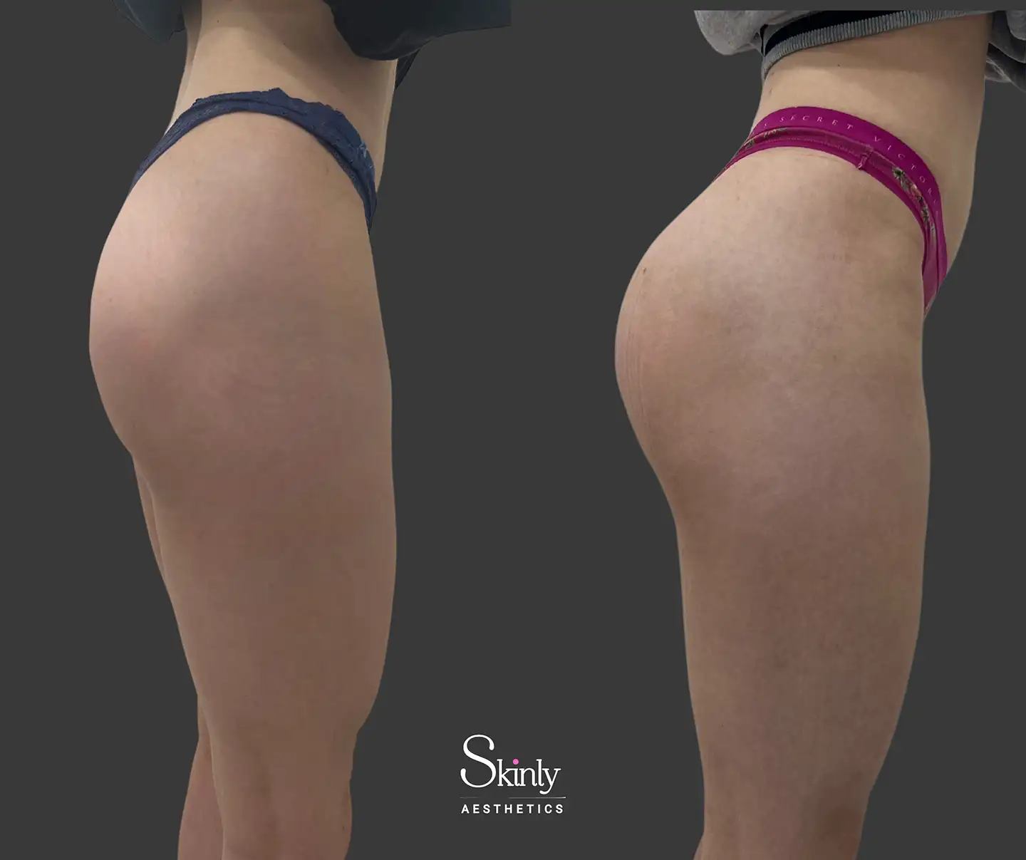 Side profile of buttocks after non-surgical Liquid Butt Lift