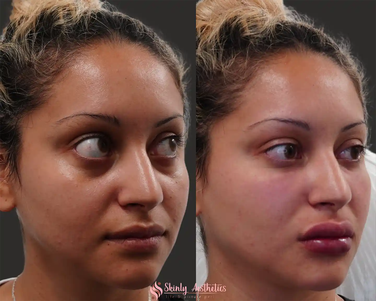 45-degree angle view of Liquid Facelift results by Dr. Schwarzburg in NYC