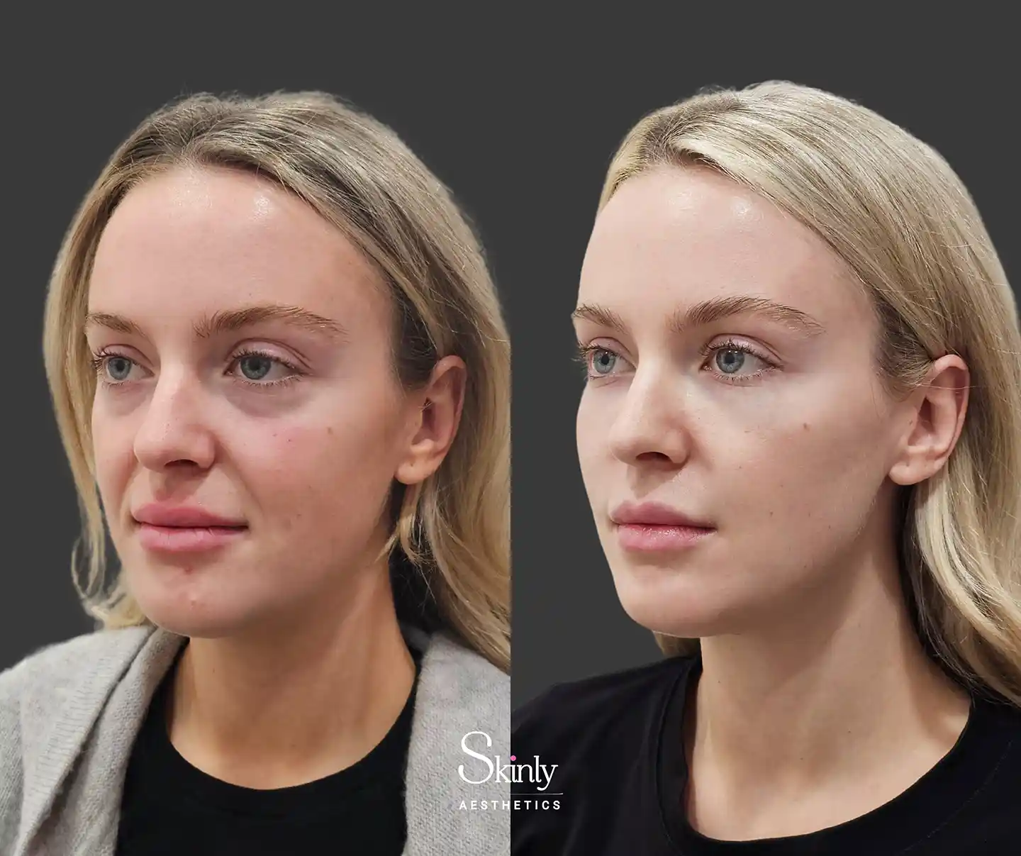 45 degree angle facial contour improvement with Liquid Facelift, before and after results