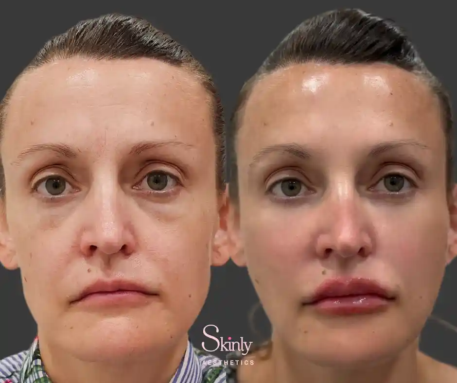 Full face Liquid Facelift before and after results in NYC by Dr. Schwarzburg