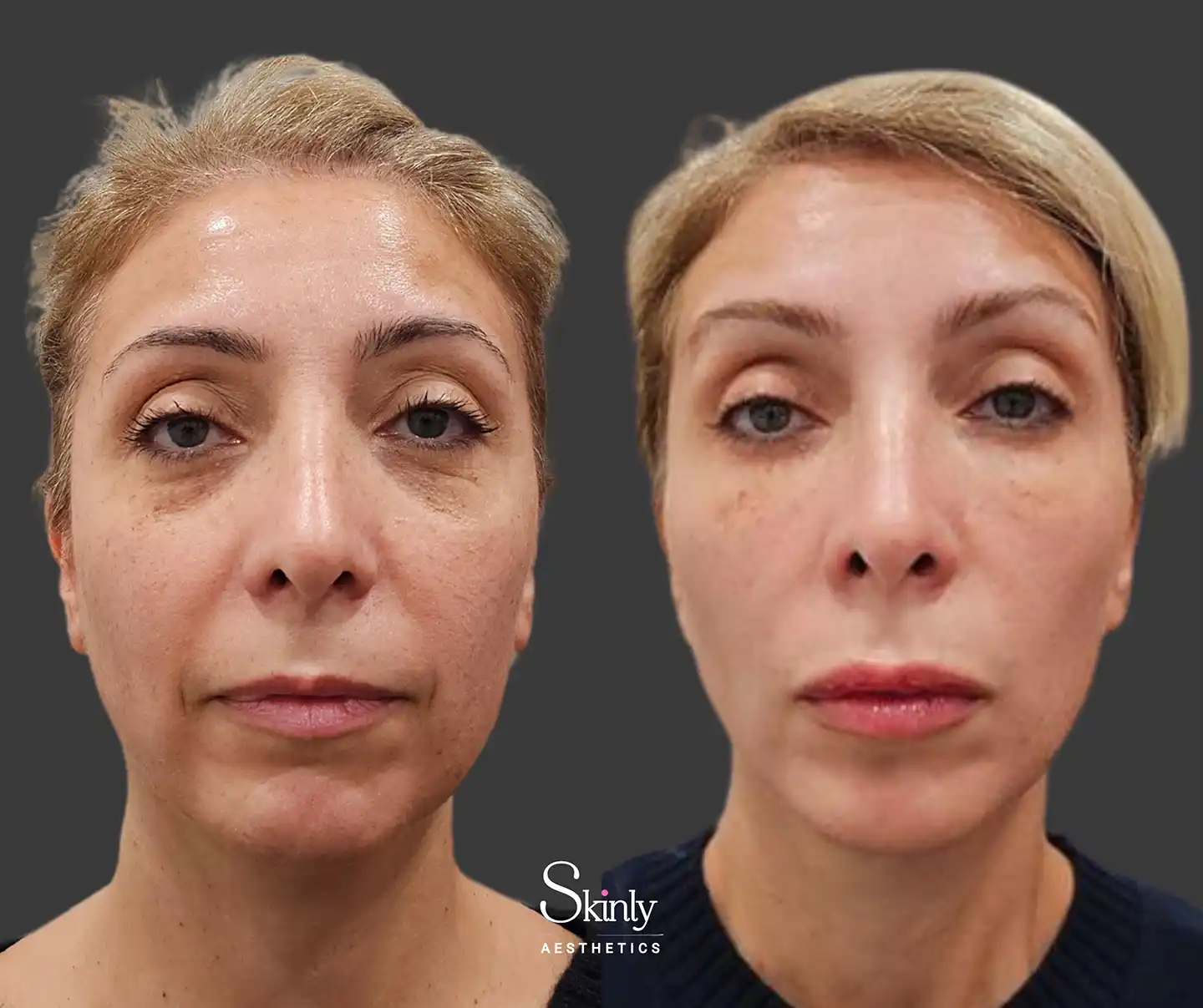 Front image showcasing elevated eyebrows and a refreshed midface following liquid facelift treatment