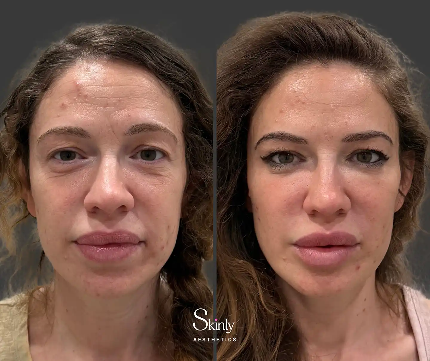 Patient appears 20 years younger after Liquid Facelift at Skinly Aestheitcs