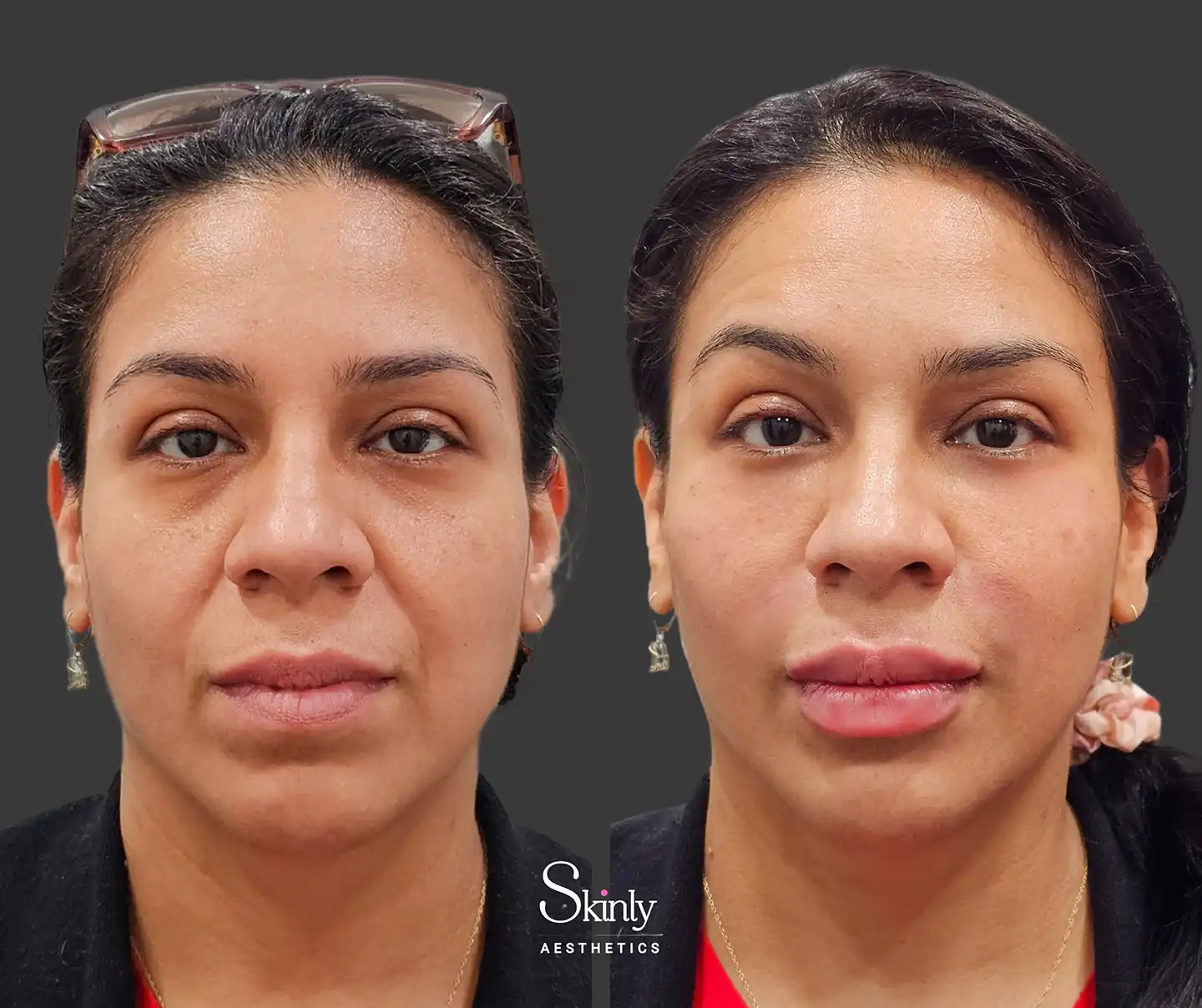 Front-facing before-and-after clearly showing smoother skin texture and rejuvenated under-eye region for a younger appearance after liquid facelift.