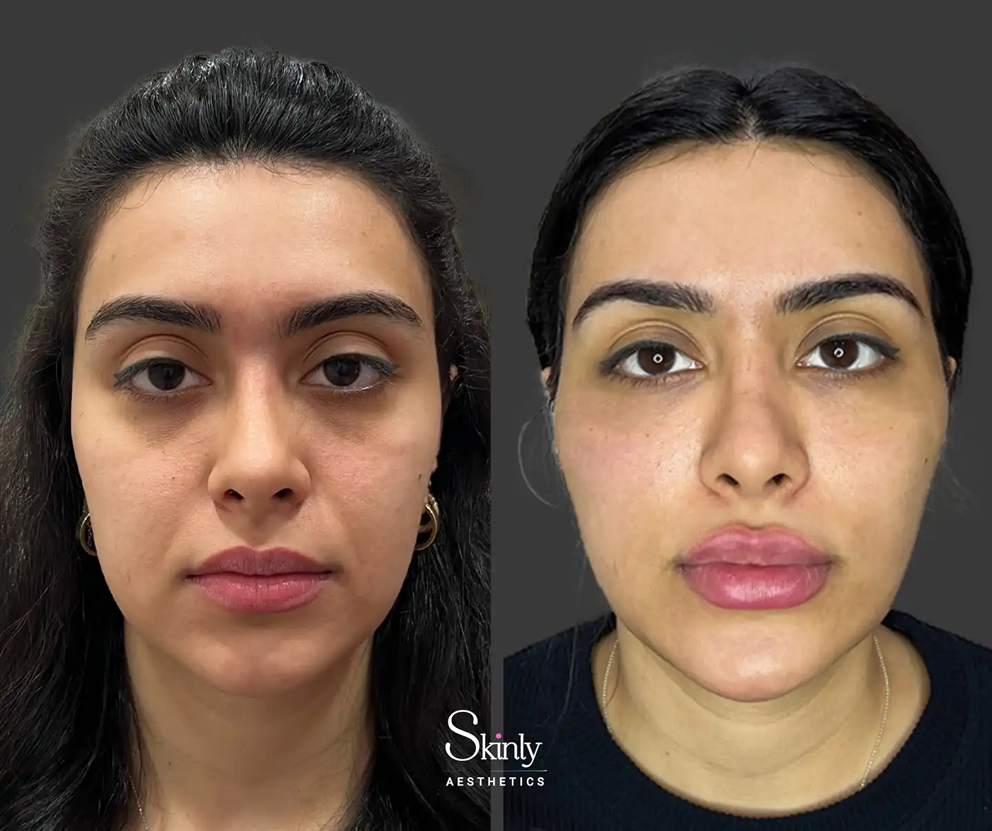 Comprehensive rejuvenation with smoother skin, defined lips, lifted eyebrows, and refreshed under-eye area following a liquid facelift.