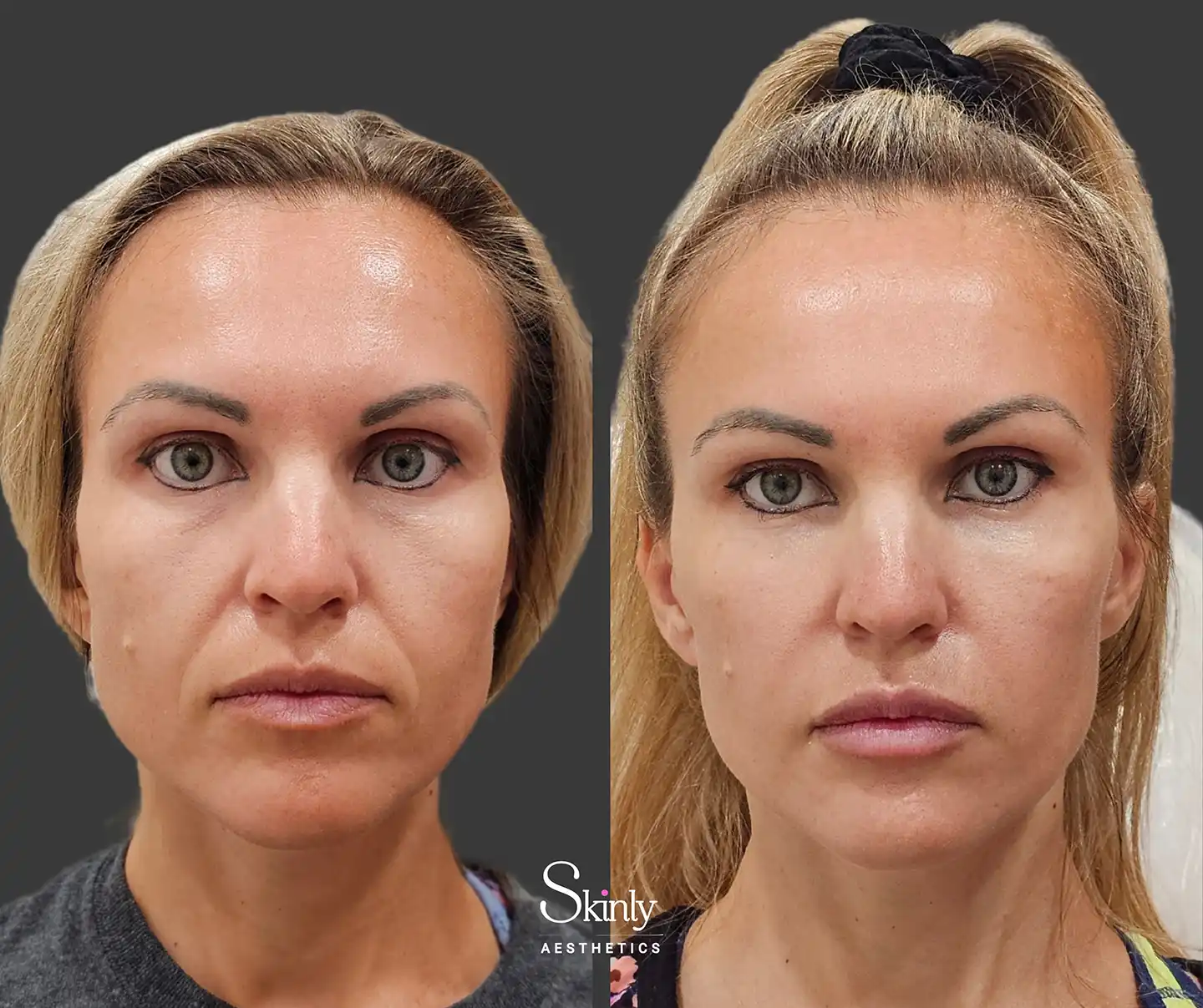 Front view highlighting overall restored facial volume, reduced sagging, and a visibly plumper, youthful appearance following liquid facelift.