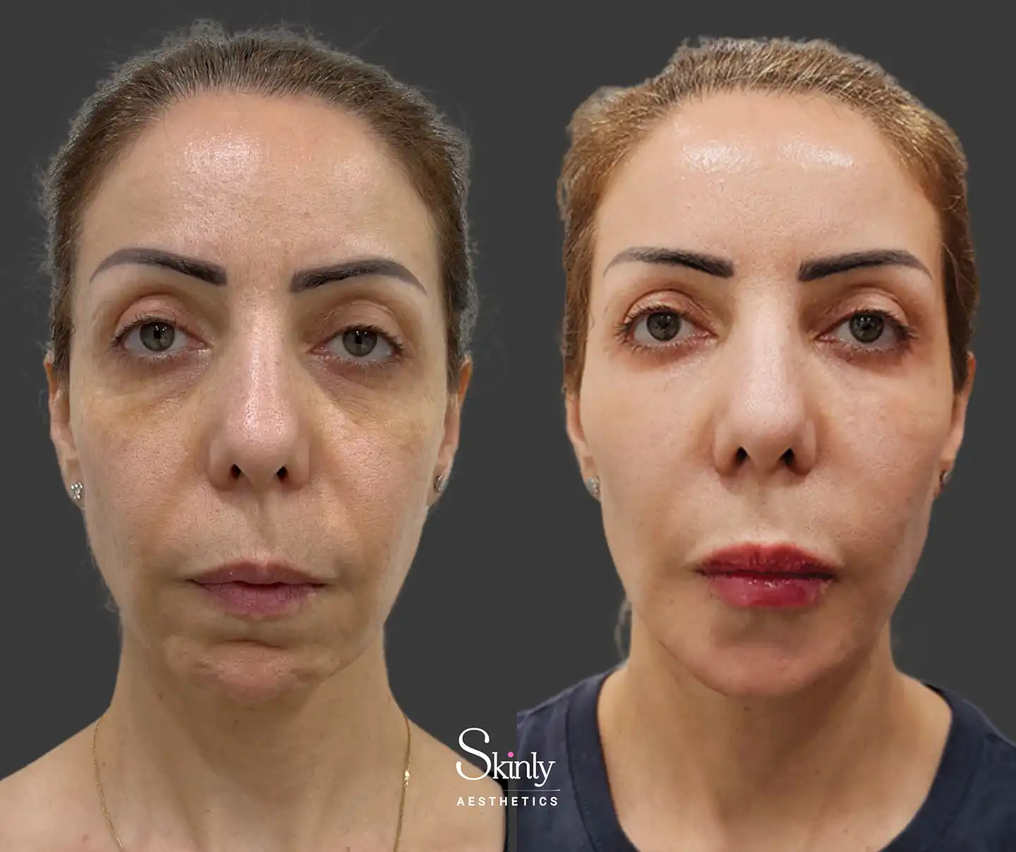 Front-facing view highlighting revitalized under-eye area, enhanced lip volume, and overall facial fullness achieved through a liquid facelift