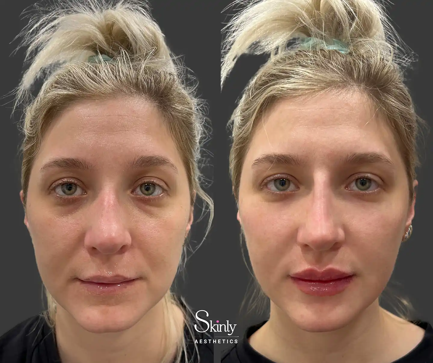 Frontal perspective highlighting comprehensive facial rejuvenation and refreshment achieved with liquid facelift.