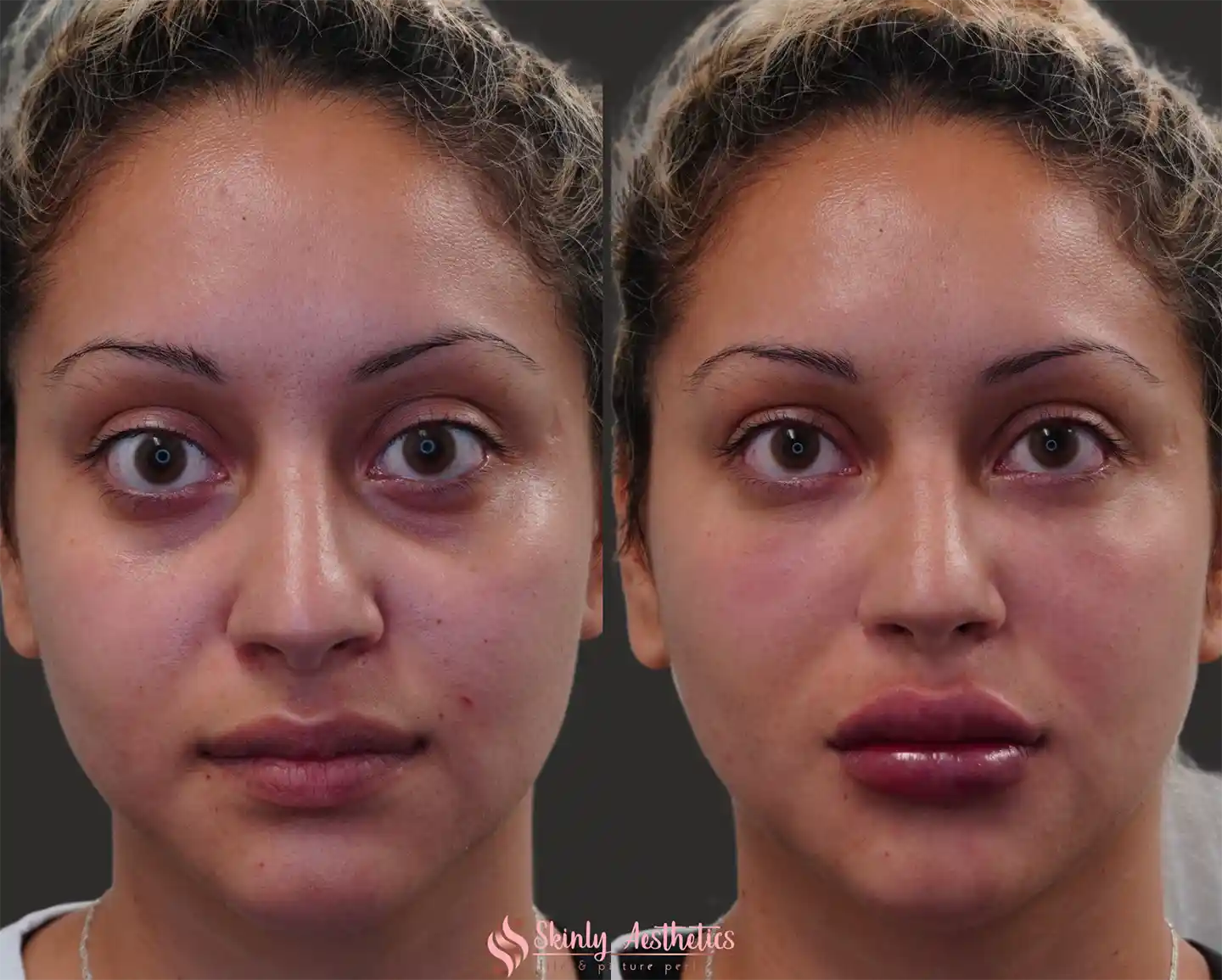 Full-face rejuvenation results from Liquid Facelift at Skinly Aesthetics NYC