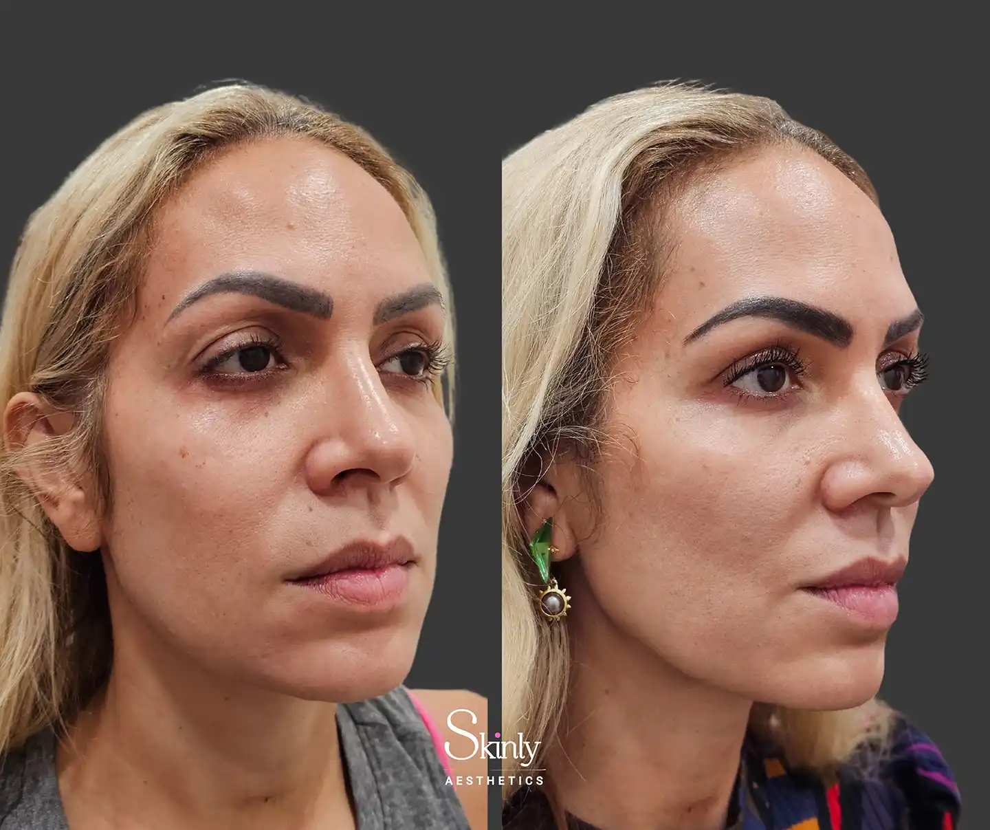 Refreshed and lifted lips, smoother nasolabial folds, elevated eyebrows, and brighter under-eye area after a Liquid Facelift