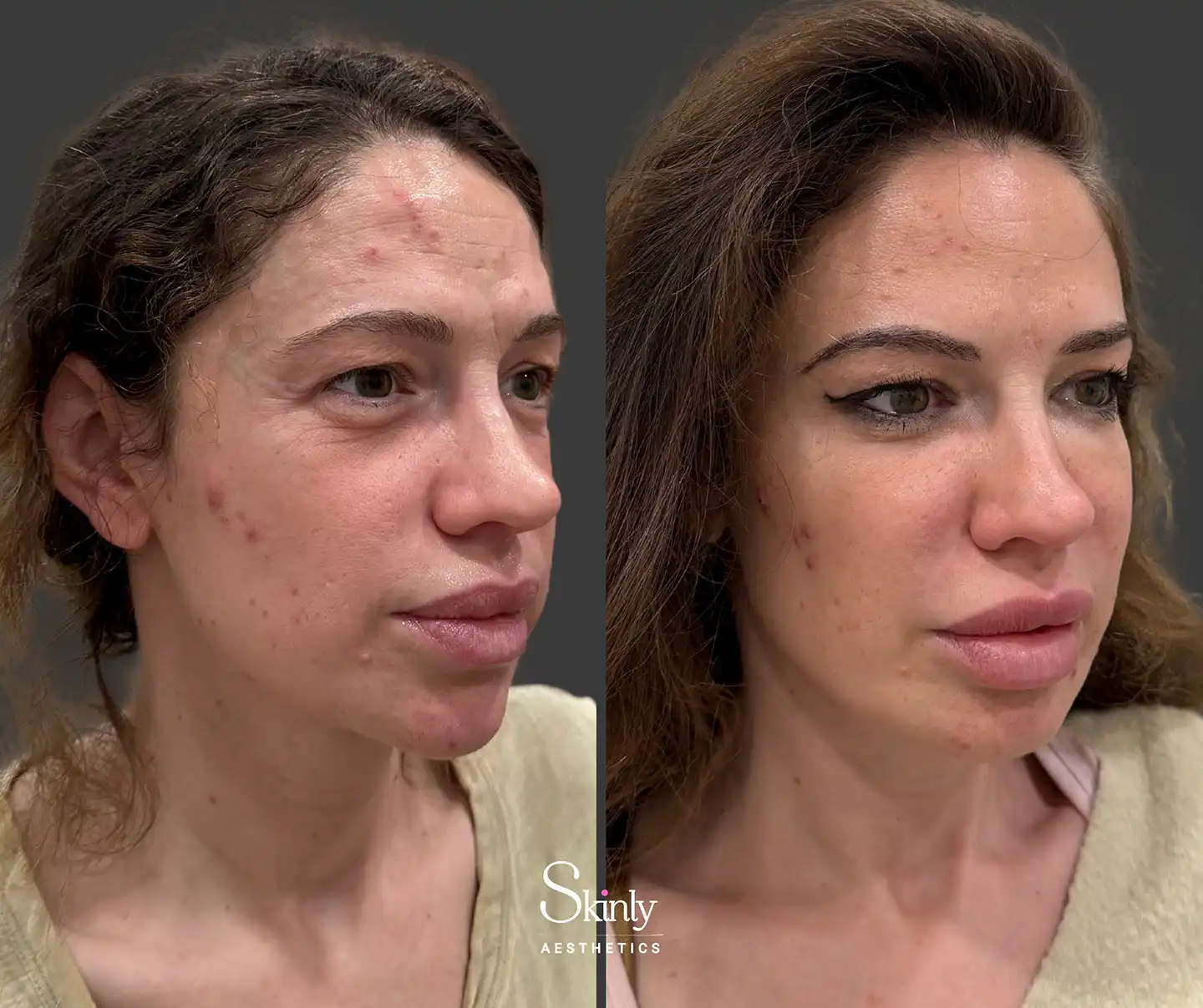 Side profile demonstrating enhanced cheek contours and lifted facial structure post-liquid facelift.