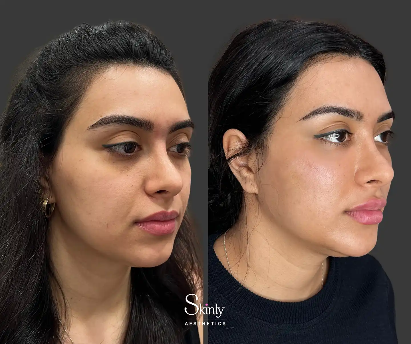 Side image capturing youthful enhancement of cheek volume, improved jawline contour, and subtly elevated brows following a liquid facelift.