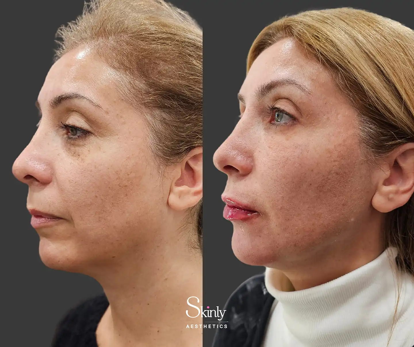 Side view highlighting tighter skin and a more defined jawline achieved through liquid facelift