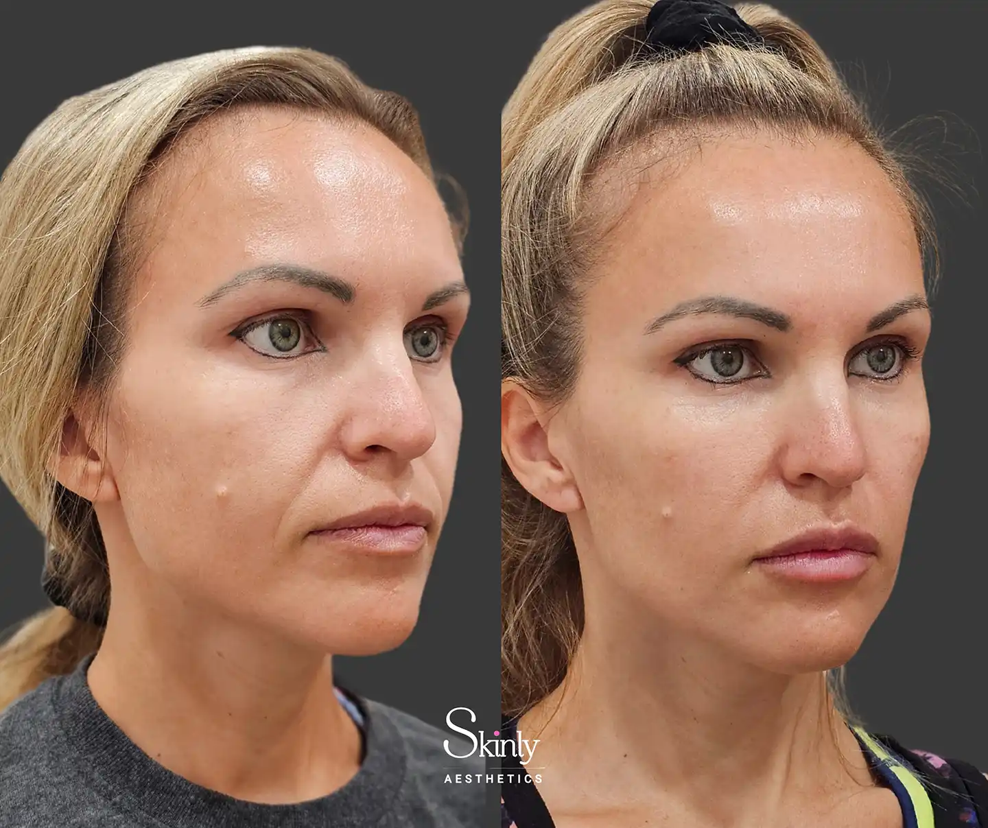 Cheek and mid-face rejuvenation and restored facial volume post-liquid facelift