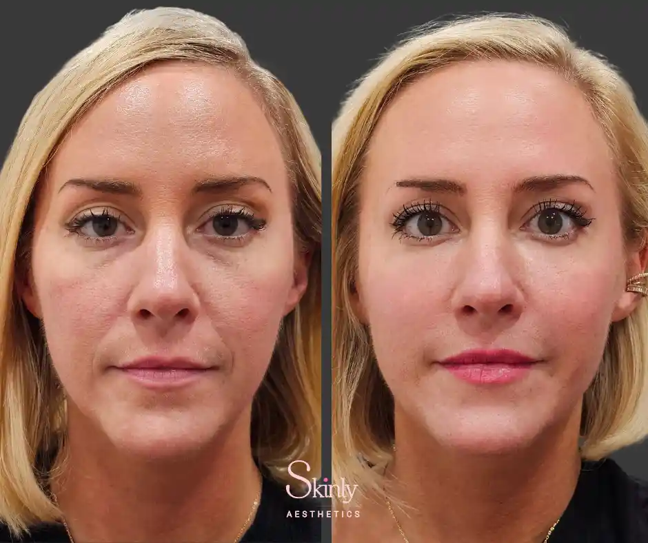 Improved skin texture and reduced under-eye hollows for an overall refreshed and younger appearance after Liquid Facelift