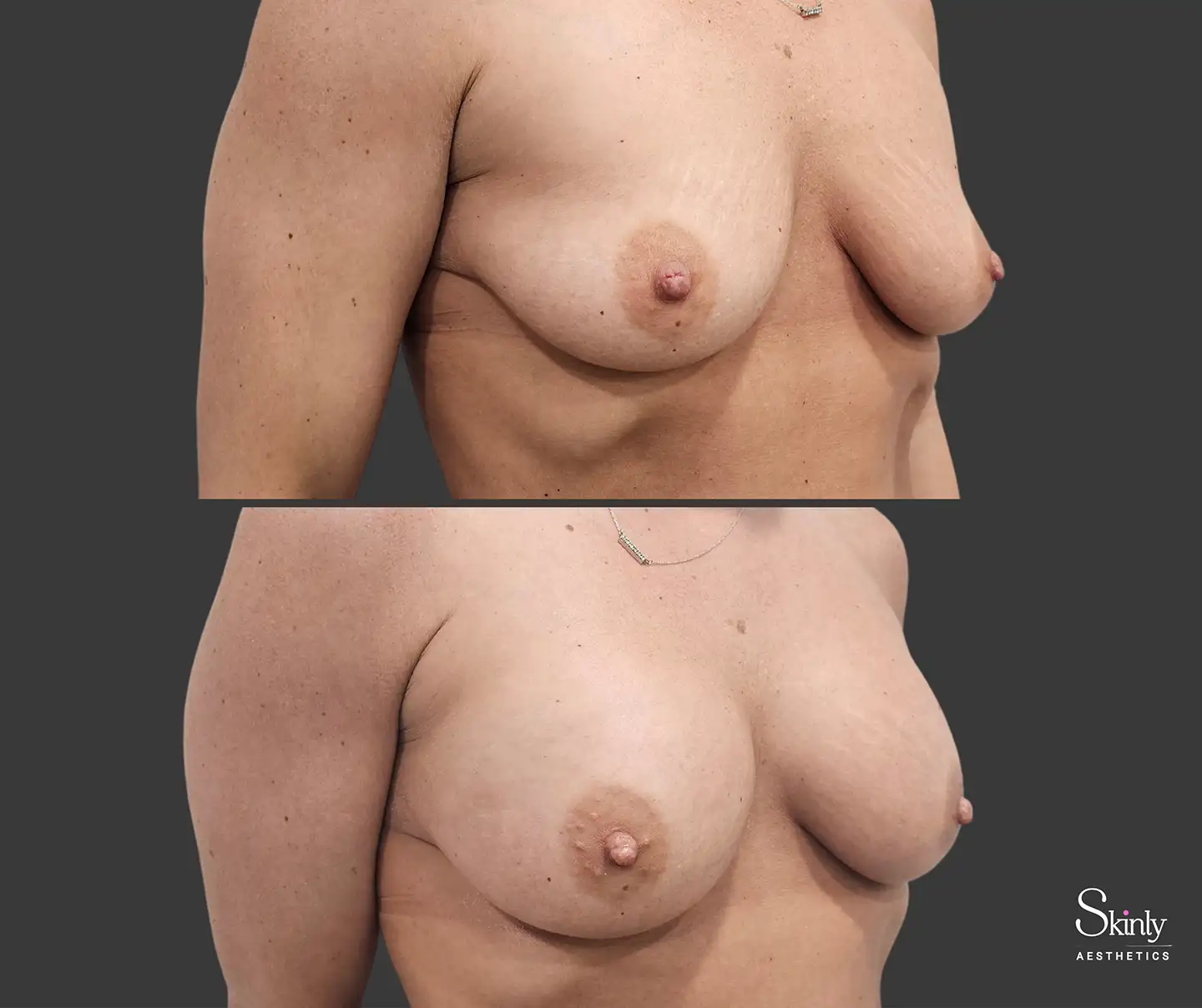 Noticeable breast enhancement with a natural appearance after non-surgical treatment