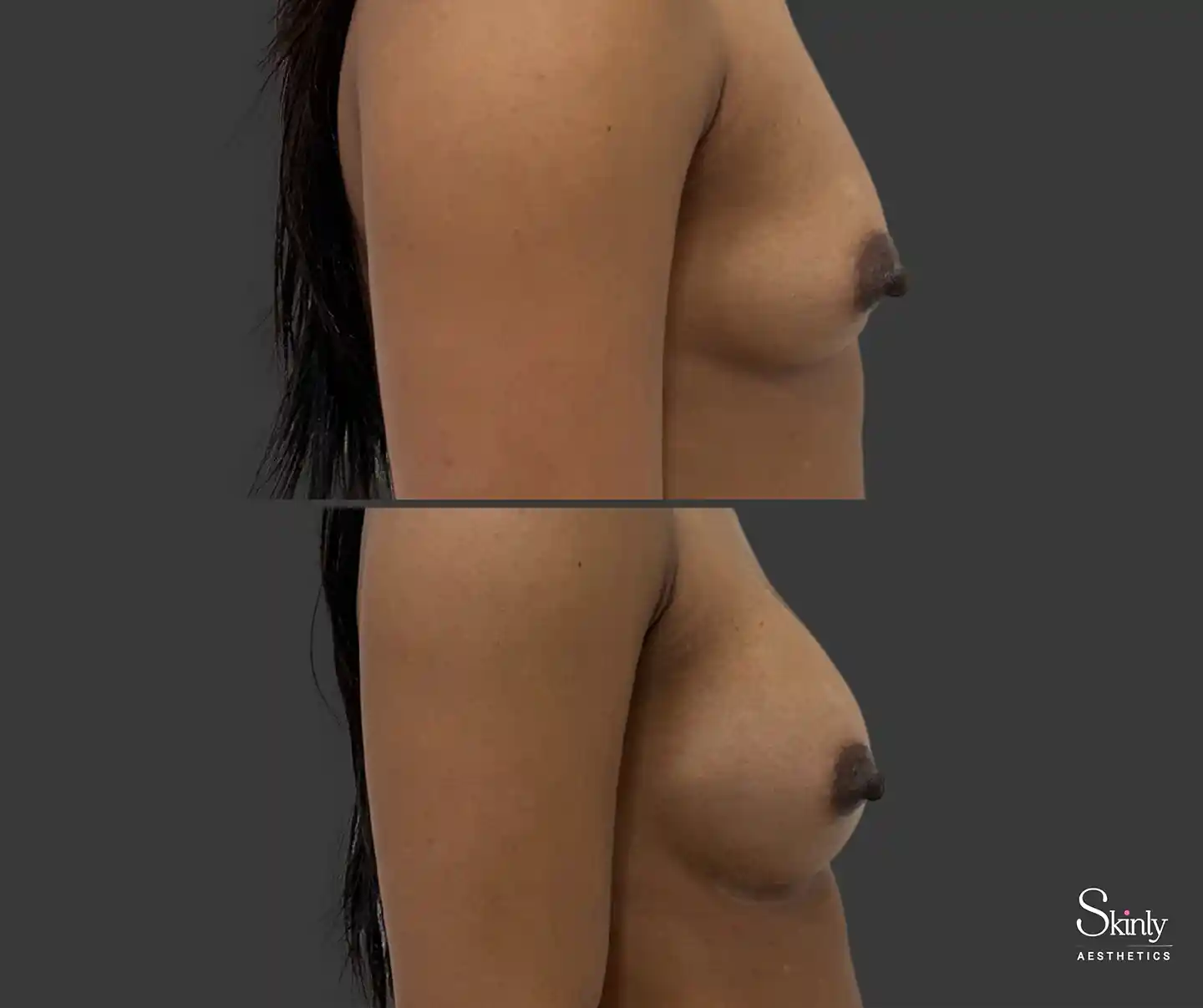 Dramatic yet natural-looking breast enhancement results seen from the side