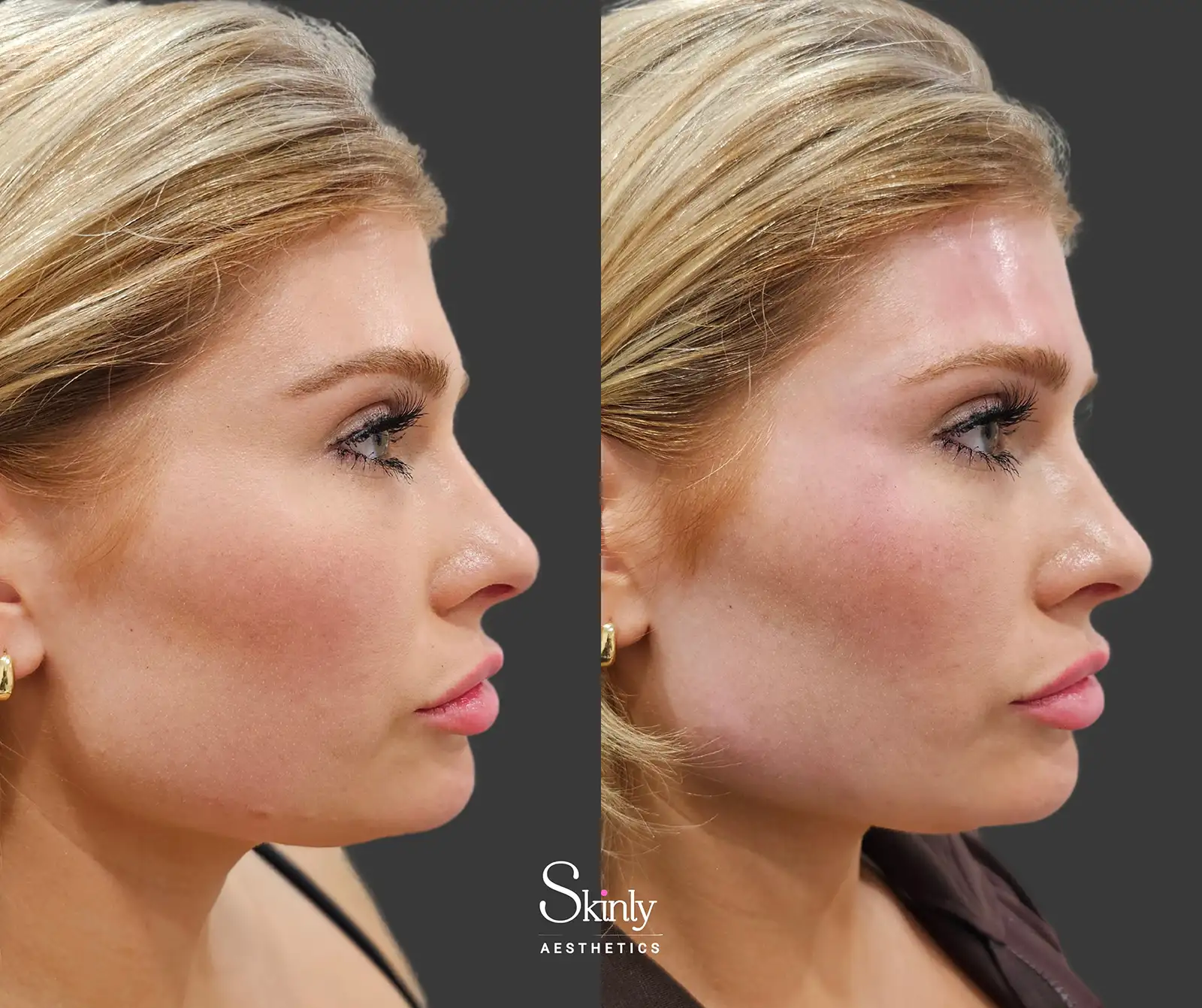 Natural side view result after forehead filler treatment with Dr. Schwarzburg in NYC