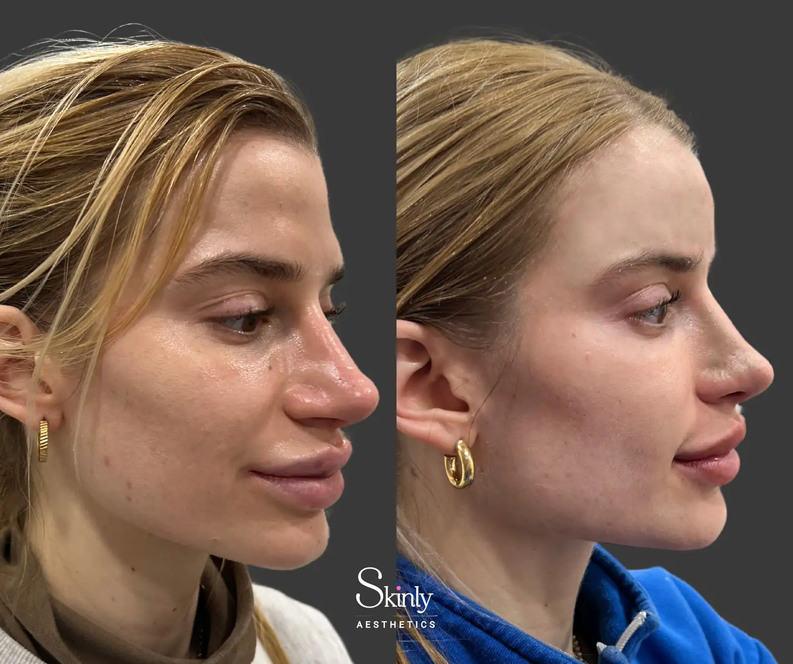 Side profile showing enhanced forehead curvature after indentation filler at Skinly Aesthetics.