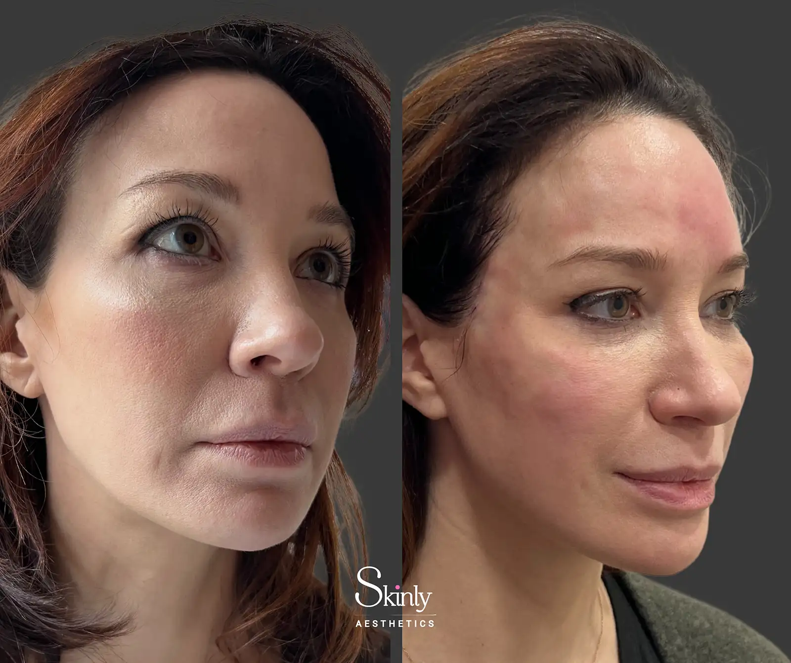 Subtle reshaping of a naturally flat forehead using hyaluronic acid filler for a more rounded, balanced appearance