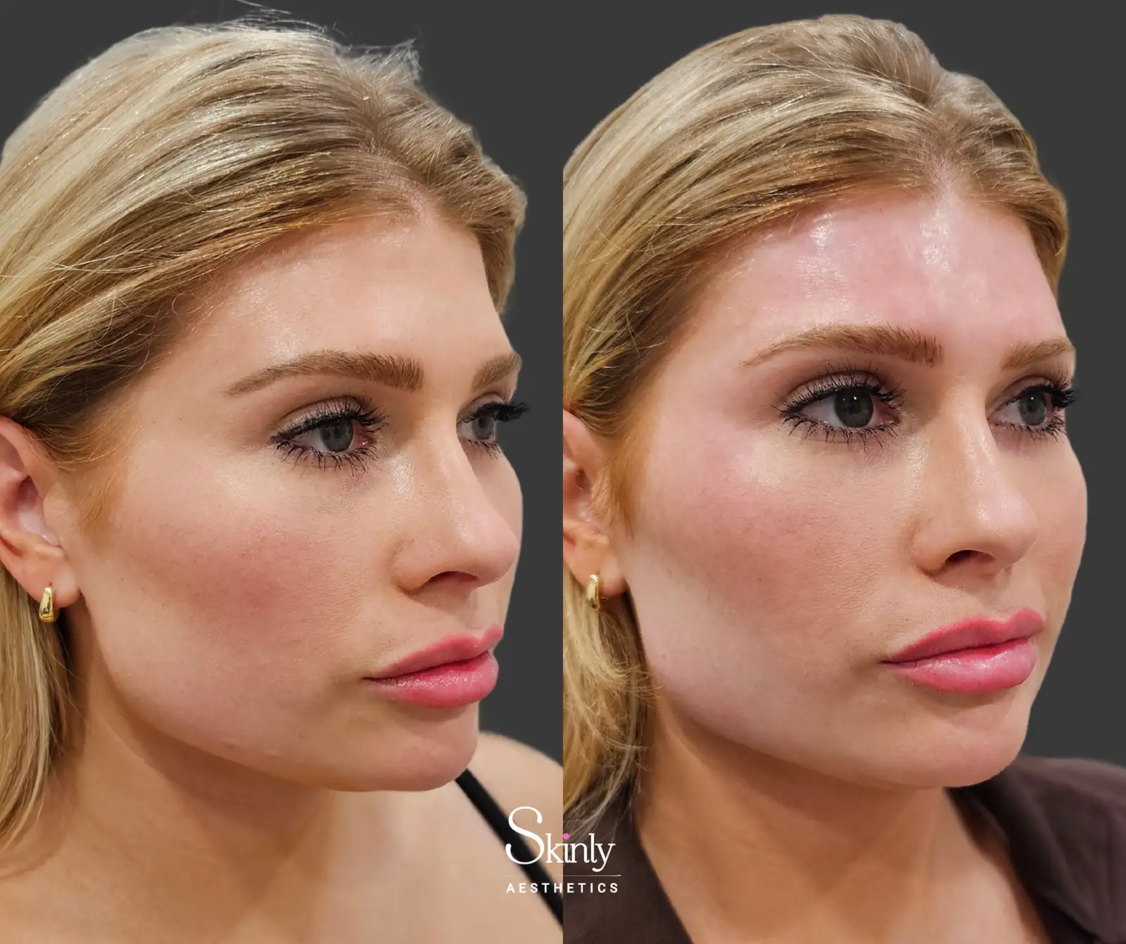 Natural forehead volume restored with expertly placed filler injections by Dr. Schwarzburg