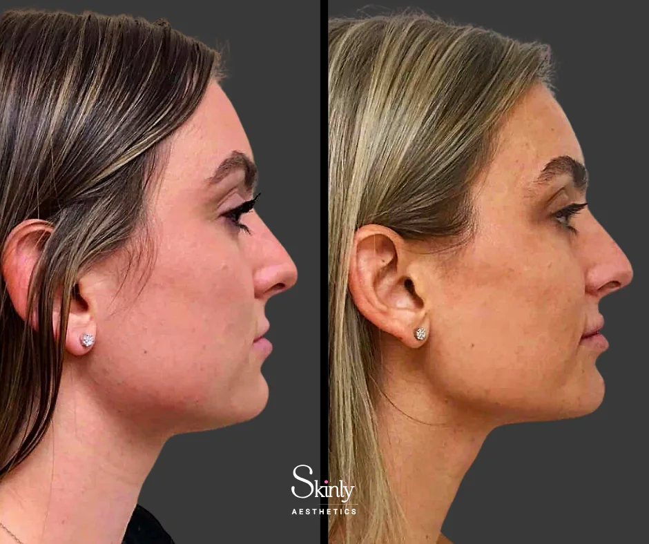 Double chin reduction with Kybella – performed at Skinly Aesthetics in New York City.