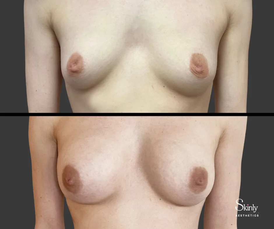 Enhanced shape after breast lift with filler – top before, bottom after.