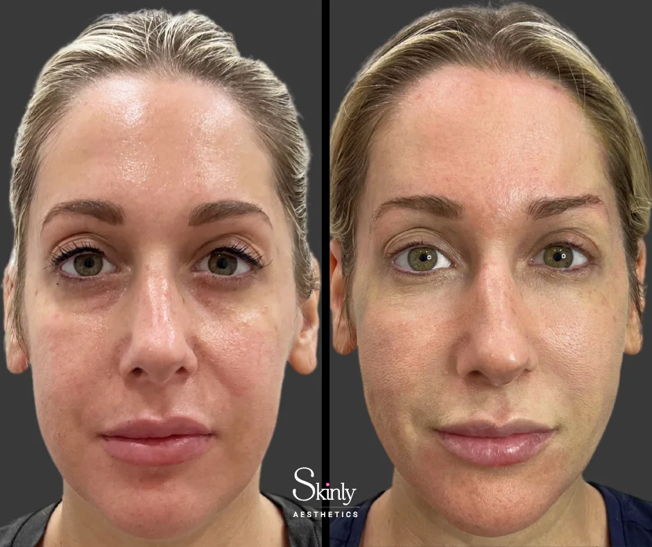 Enhanced midface structure after cheek filler – at Skinly Aesthetics in NYC.