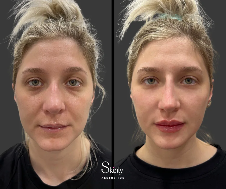 Defined cheekbones after cheek contouring with filler.