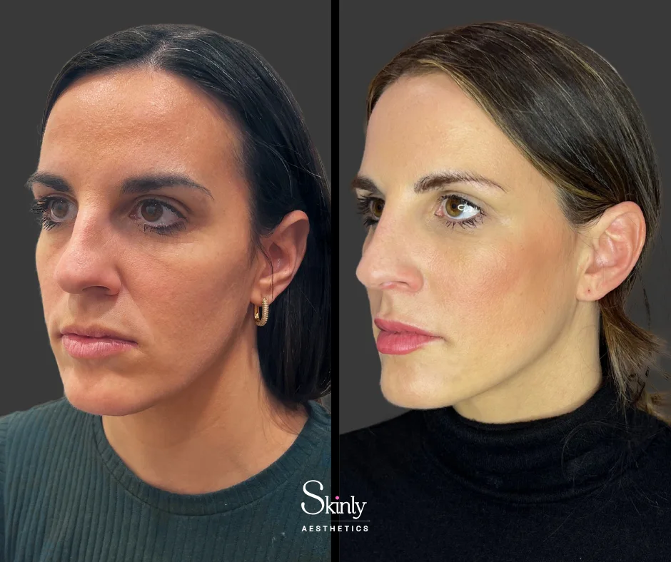 Fuller cheeks after cheek filler injections with Dr. Schwarzburg.