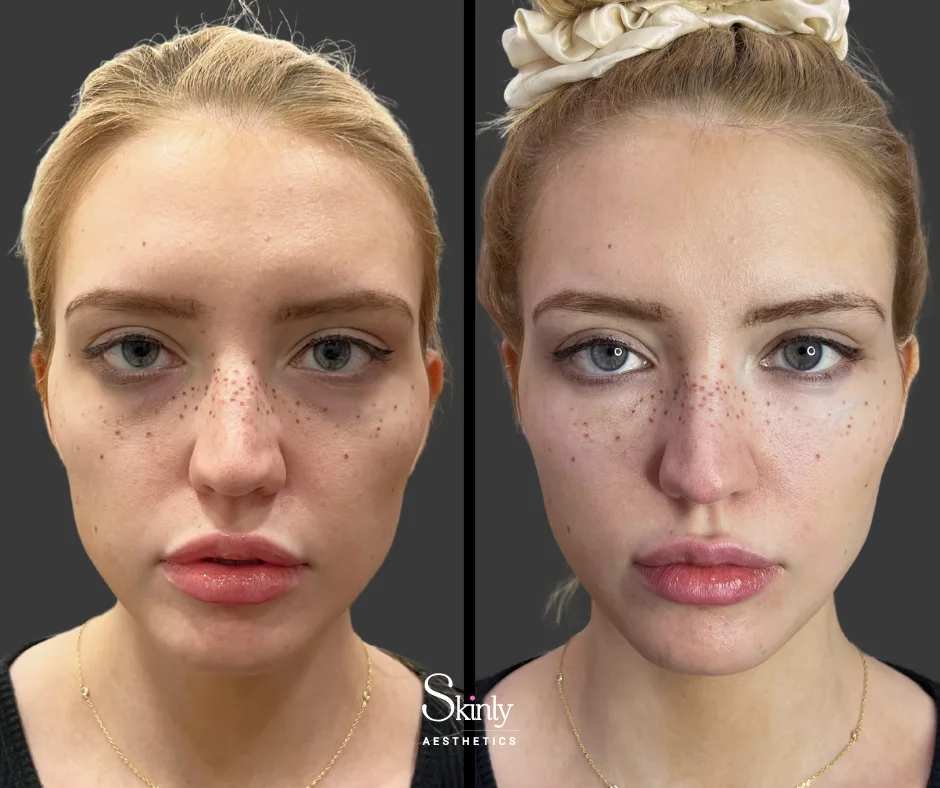 Cheek filler improving facial contour – before (left) vs after (right) in NYC.