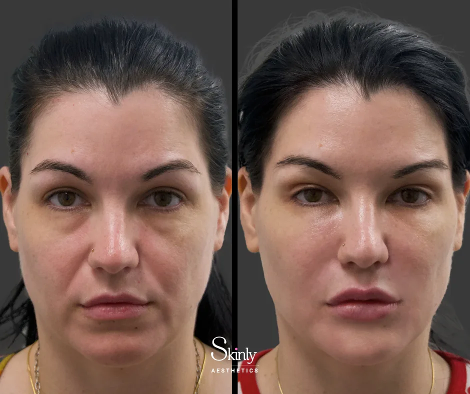 Cheek volume enhancement after dermal filler – by Dr. Schwarzburg in New York City.