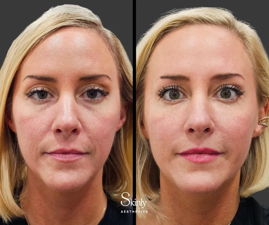 Cheekbone definition improved with dermal filler.