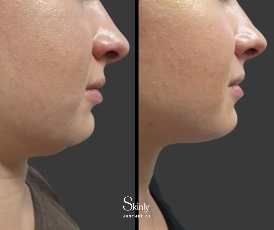 Defined jawline after chin fat removal with Kybella.