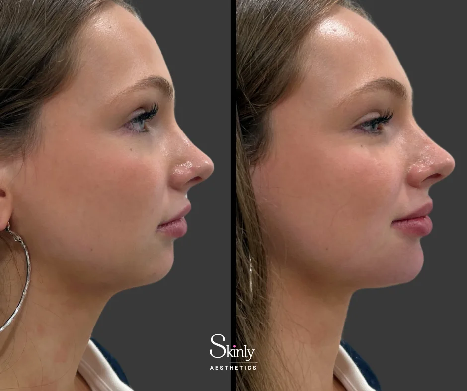 Improved facial harmony with chin filler injections.