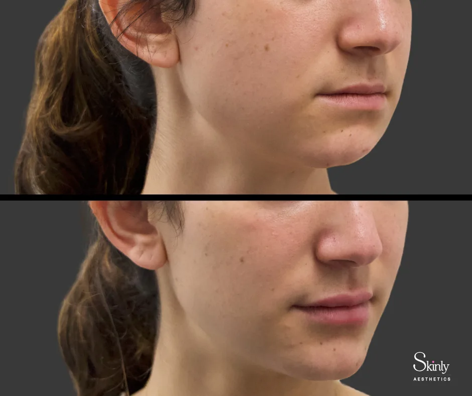Chin filler treatment enhancing projection – before (top) vs after (bottom) in NYC.