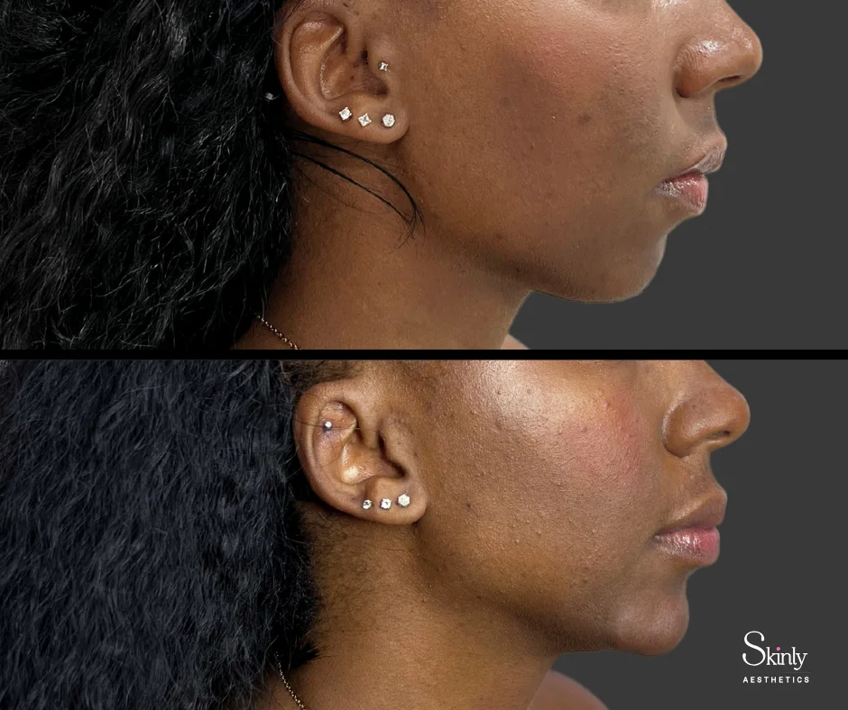 Chin shape and jawline definition improved with dermal filler treatment in NYC.
