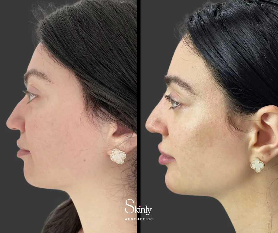 Chin filler treatment refining profile – before (left) vs after (right) in NYC.