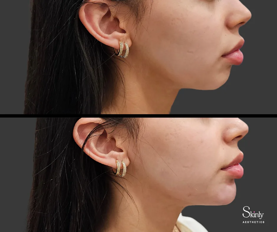 Improved facial harmony after chin filler.