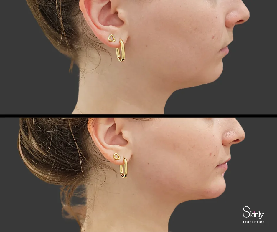 Balanced profile after chin filler – before (top) after (bottom)