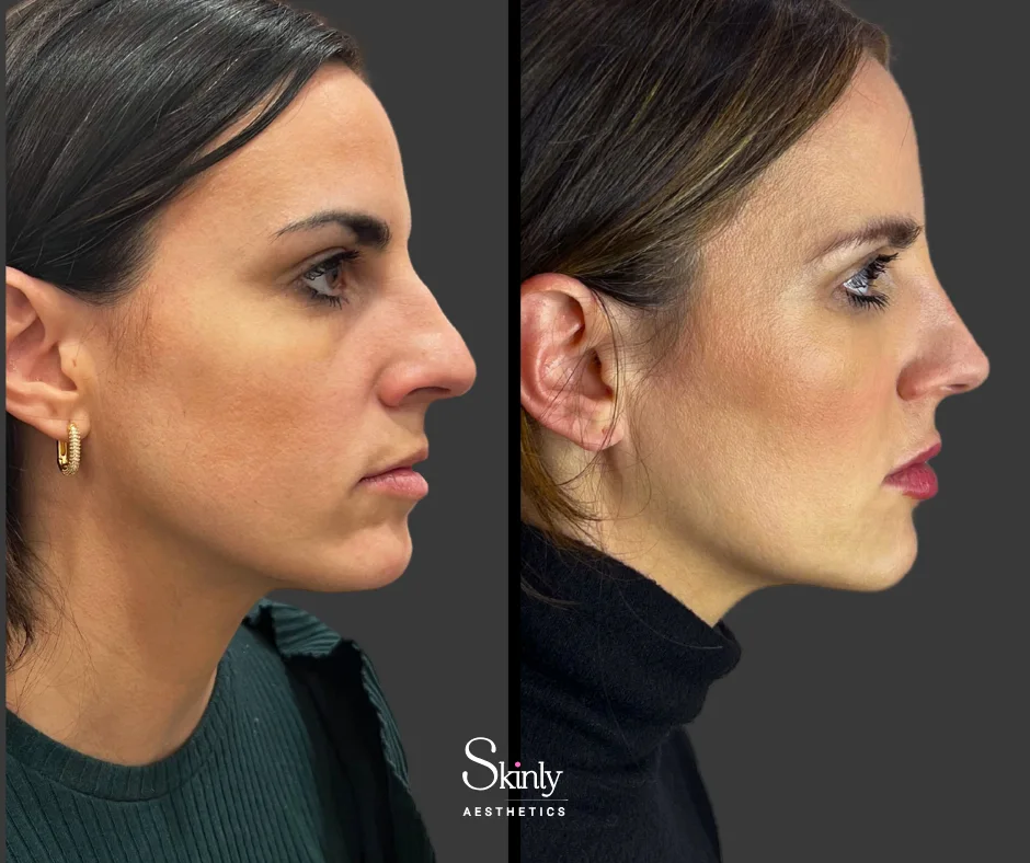 Enhanced chin projection from dermal filler in New York City.
