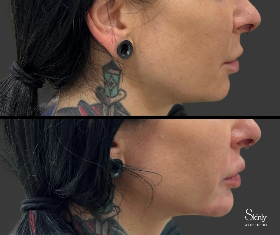 Structured lower face after chin filler treatment in NYC.