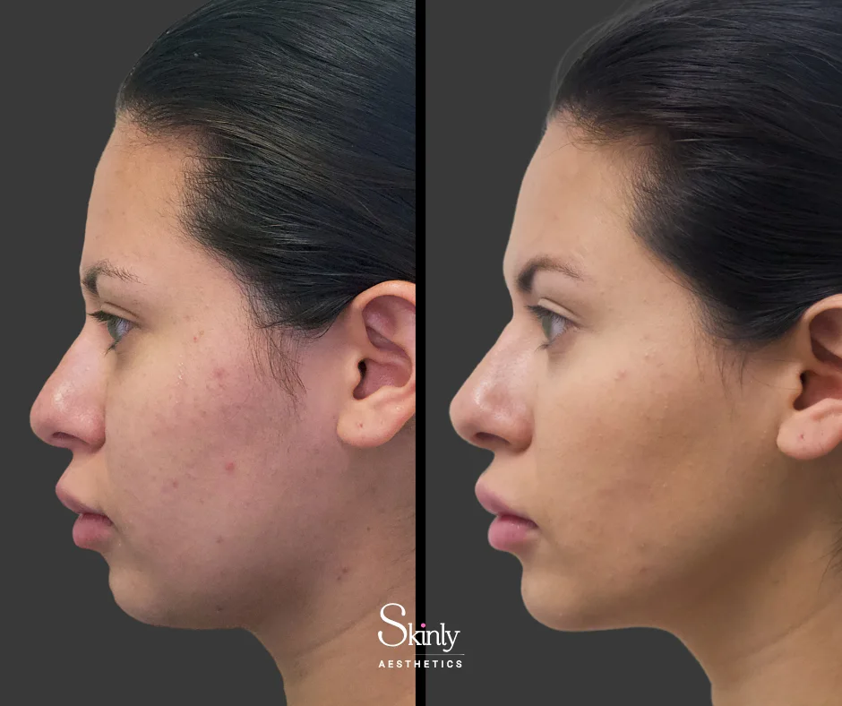 Balanced facial proportions after chin filler – at Skinly Aesthetics in New York City.