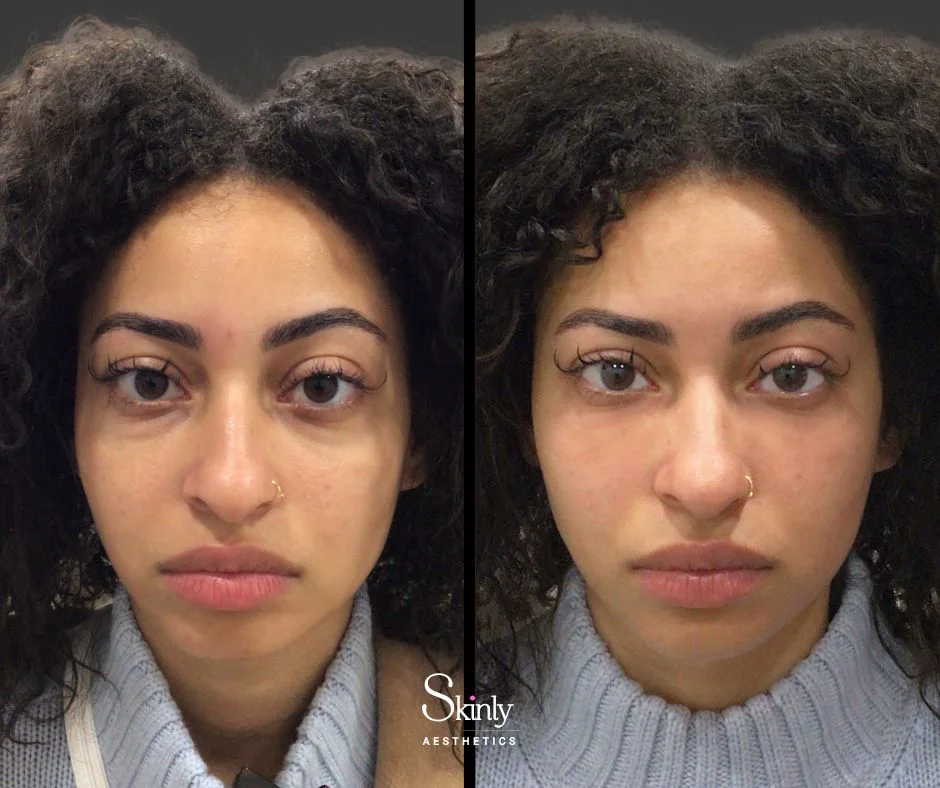 Reduced dark circles after under eye filler injections in New York City.