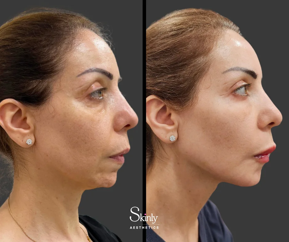 Lifted cheeks and jawline after dermal filler facelift by Dr. Schwarzburg.