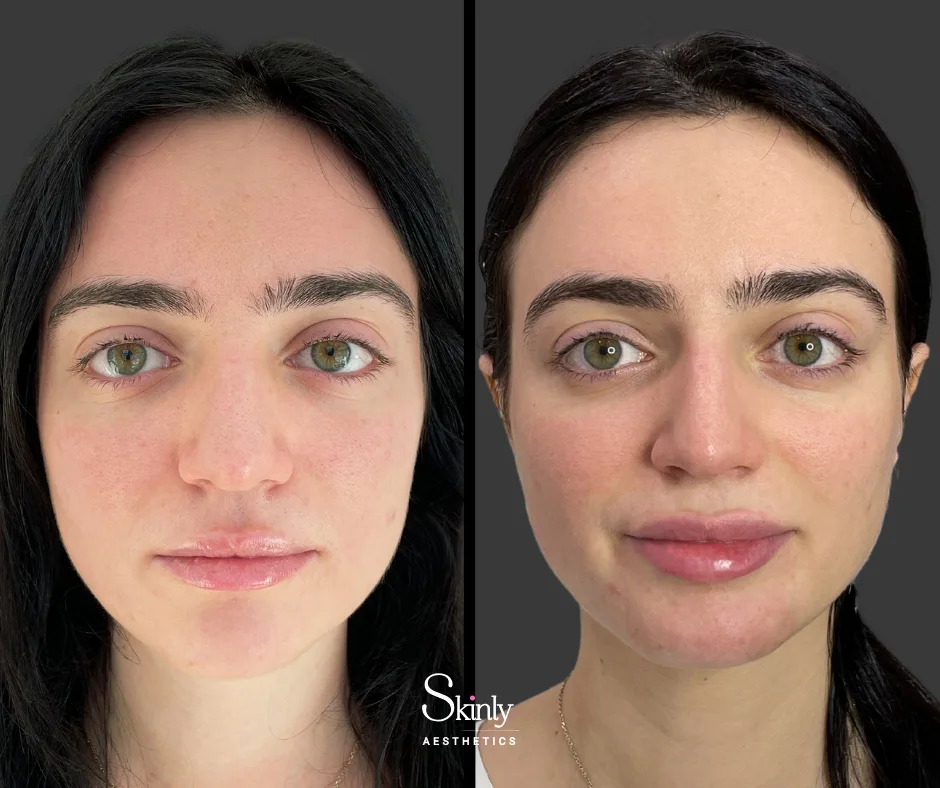 Lip enhancement with dermal filler, improving lip shape – at Skinly Aesthetics in NYC.