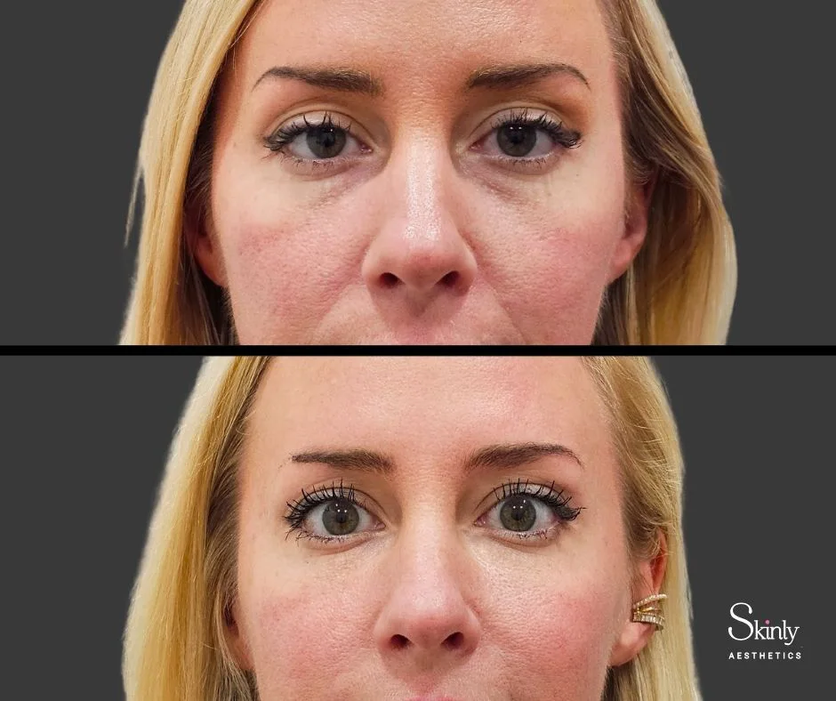 Eye bag reduction after filler treatment.