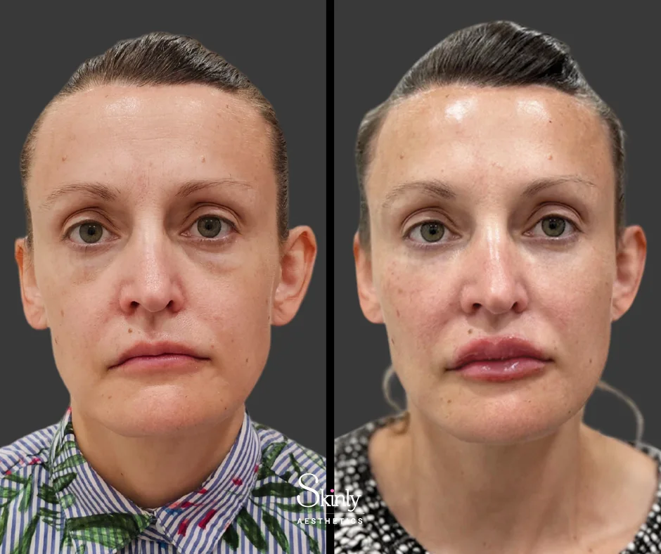 Facial balancing with cheek filler creating harmonious proportions.